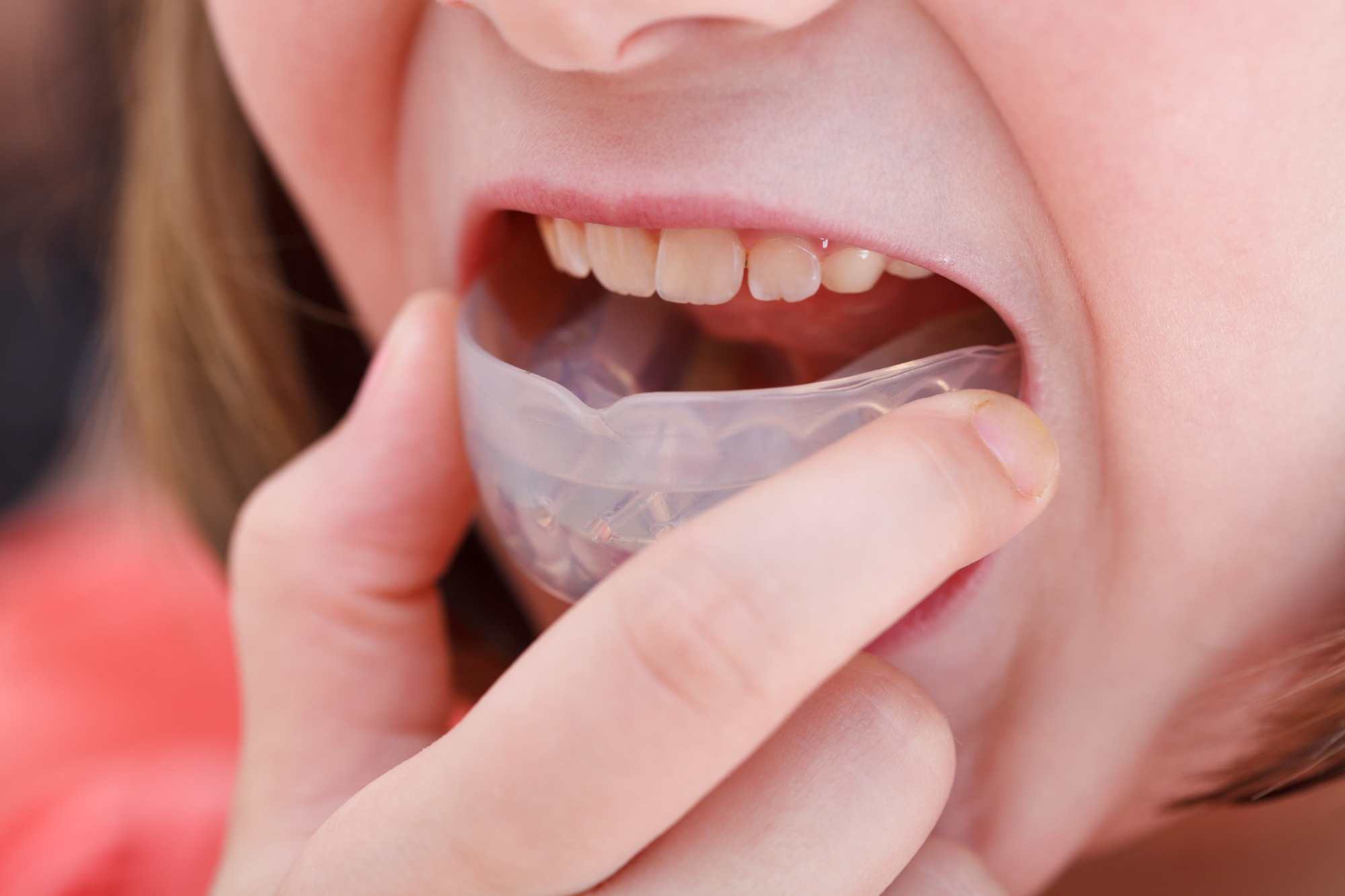 Mouthguards For Braces Riverview Orthodontics Sports Safety