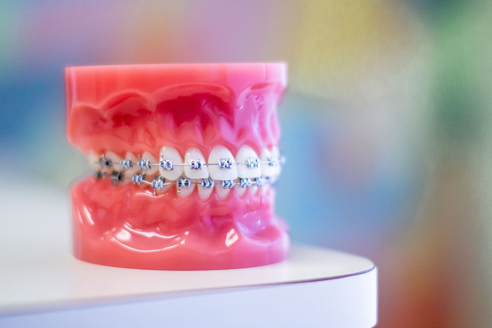 Metal Braces | Braces Tuscaloosa | Demopolis Braces